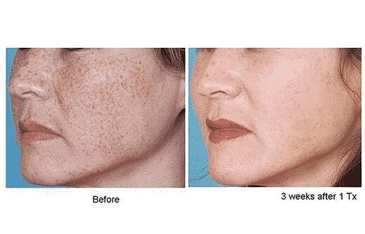 Benefits of regular PhotoFacials/BBL/IPL