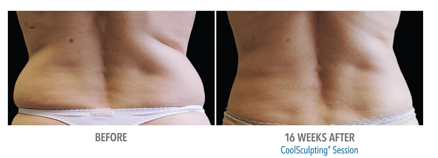 CoolSculpting – New Treatment Areas
