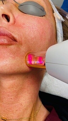How do I Know if Microneedling or Laser is Right for Me?