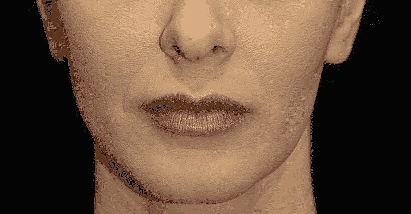 Lip Augmentation – you decide Small, Medium, or Large!