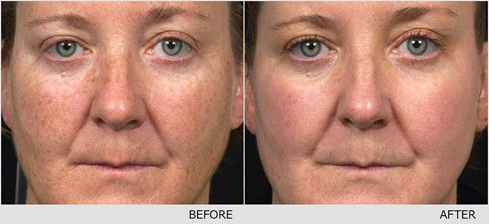 Photofractional – The 3 in 1 treatment!