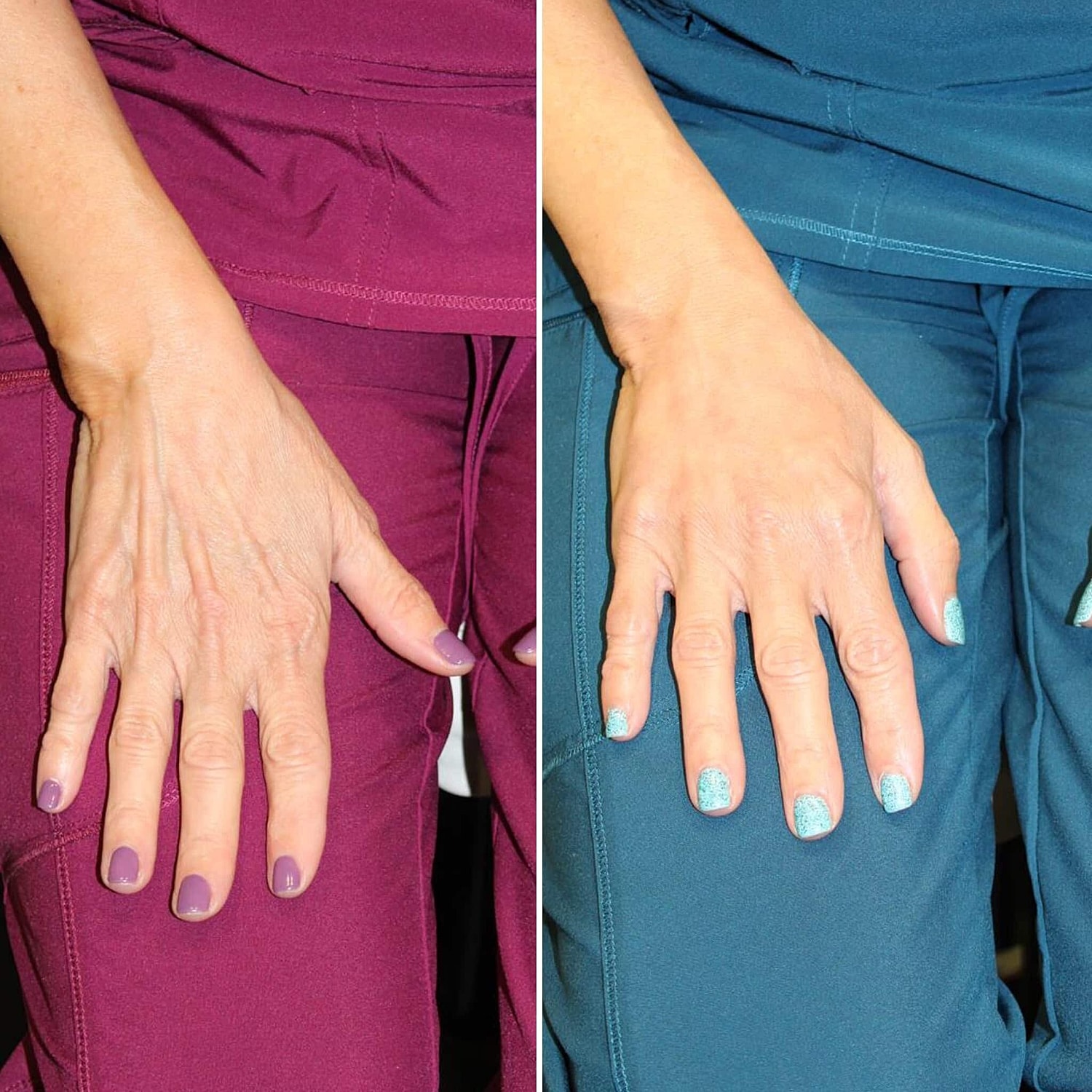 Radiesse Hands