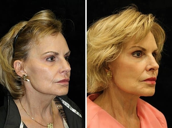 Reverse Aging – Treatments to slow/reverse the aging process