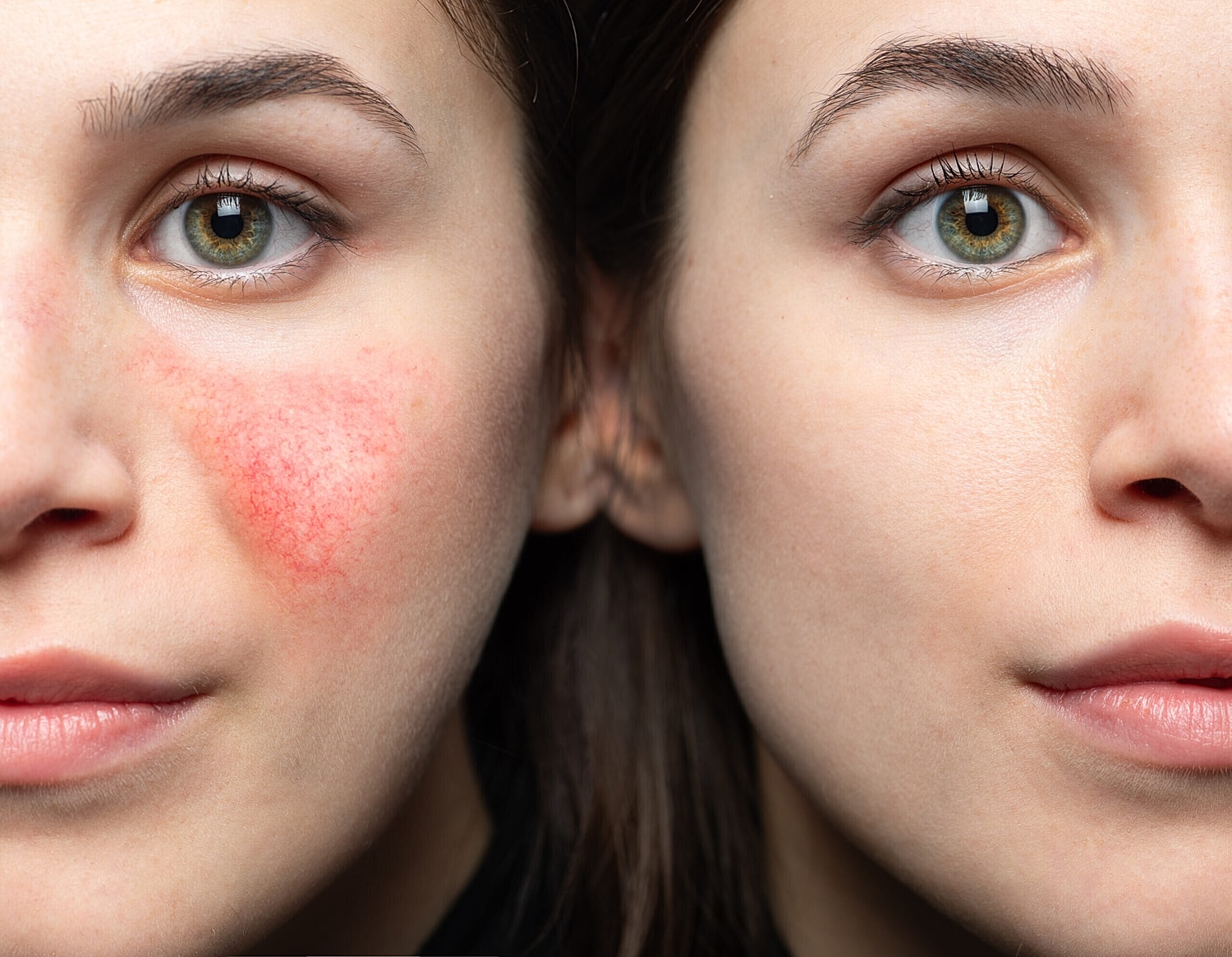 Rosacea Awareness and Treatment Options