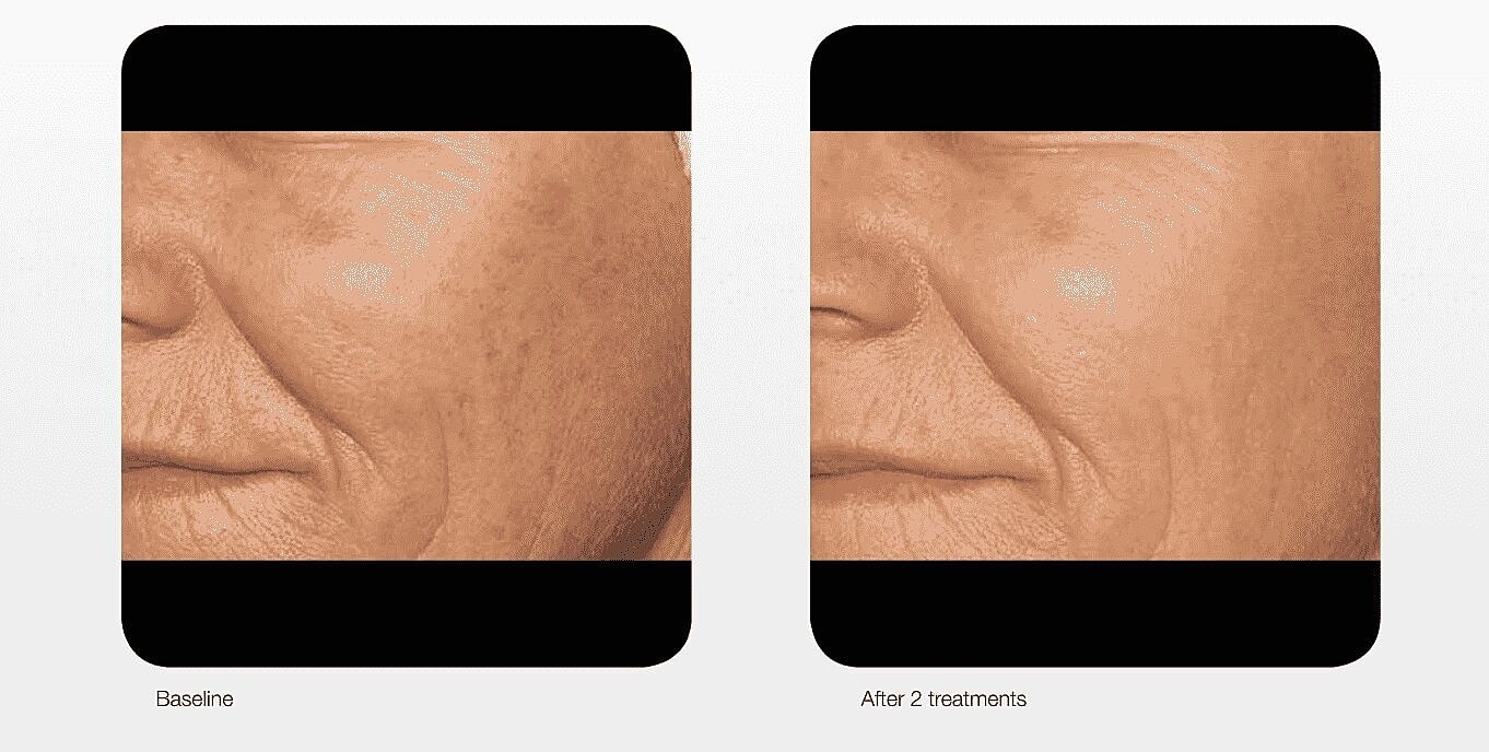 Smooth Clear Skin with Lumenis M-22