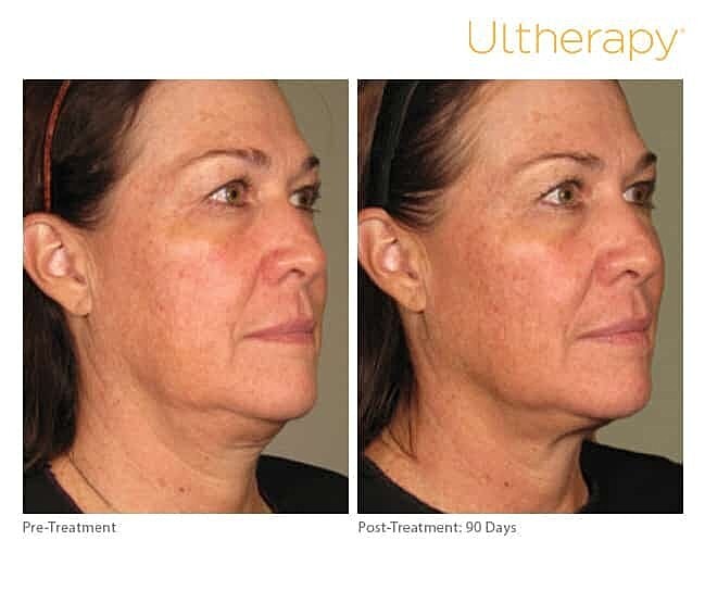 Ultherapy – Why are there mixed reviews?
