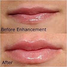 You’ve just had your lips enhanced, now what?