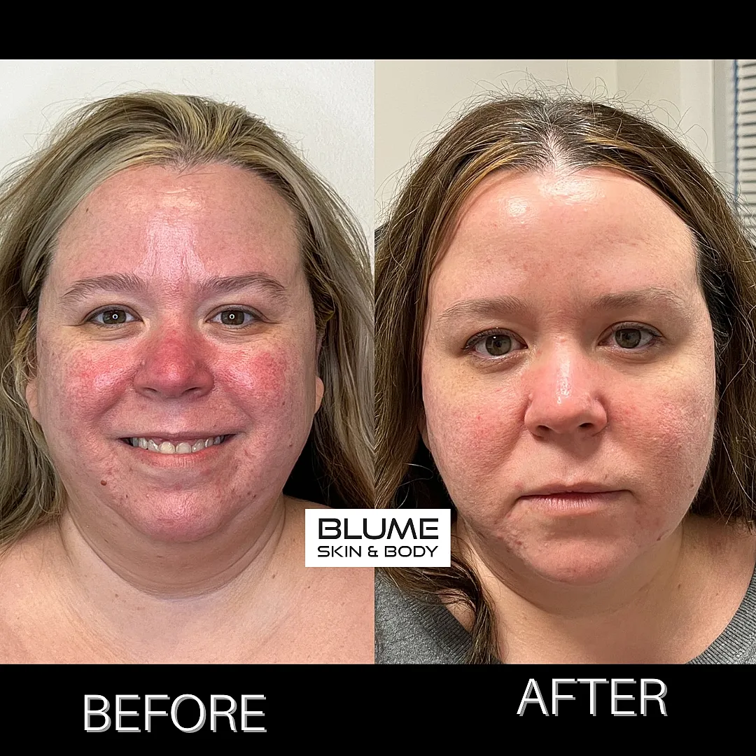 Acne treatment results: before and after comparison.