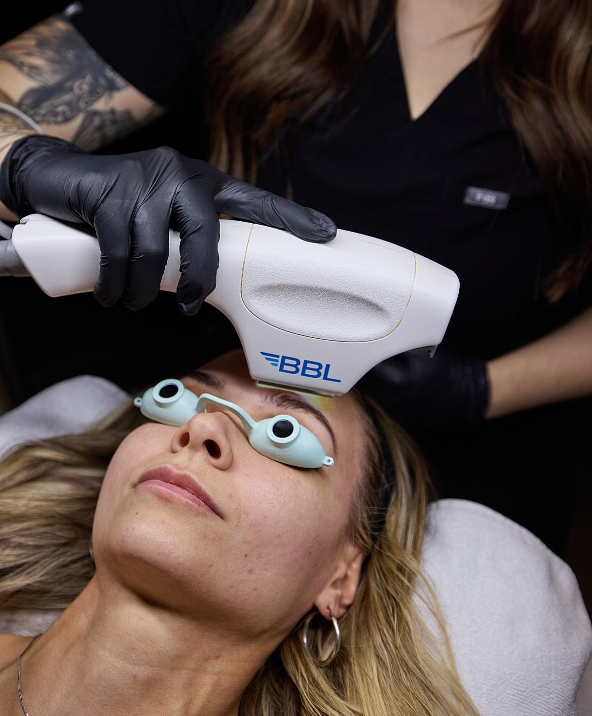 BBL treatment session for skin rejuvenation.