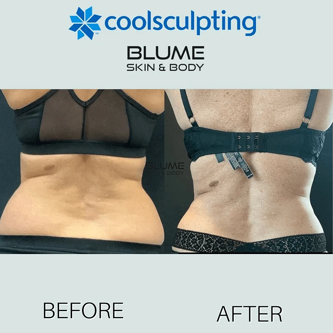 CoolSculpting results: before and after comparison.