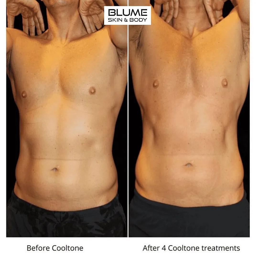 Before and after CoolTone treatment results.