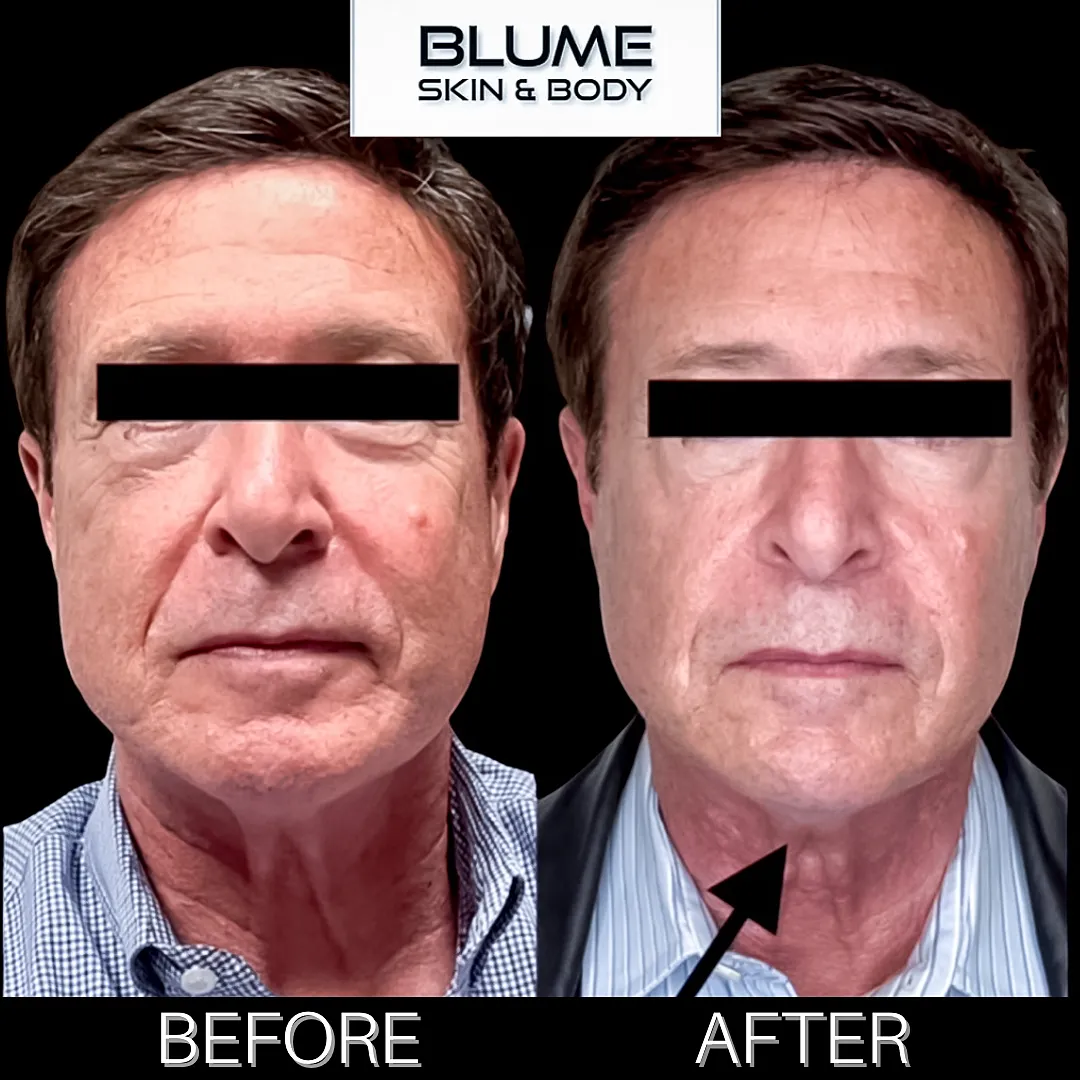 Before and after skin treatment comparison image.