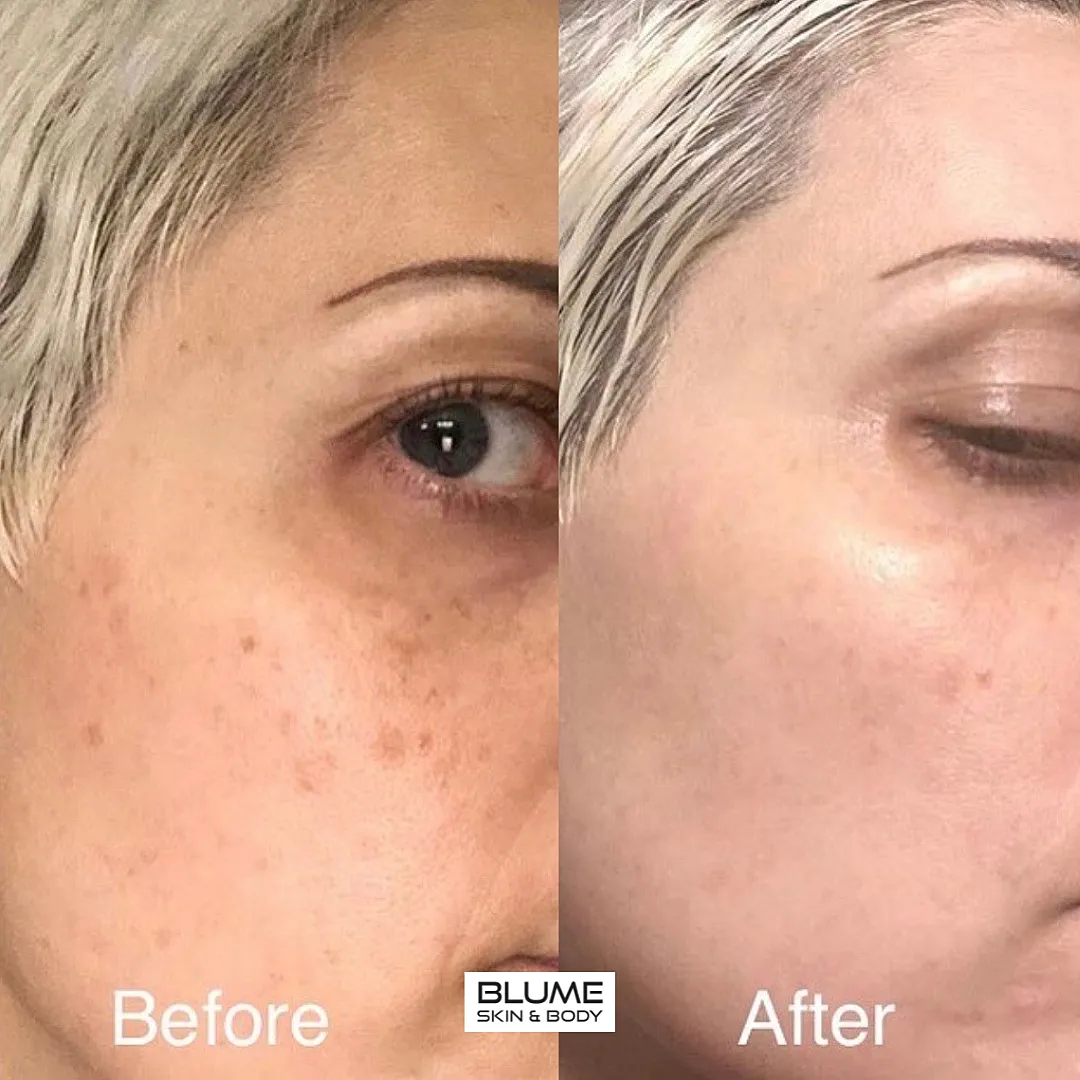 Skincare results: before and after treatment.