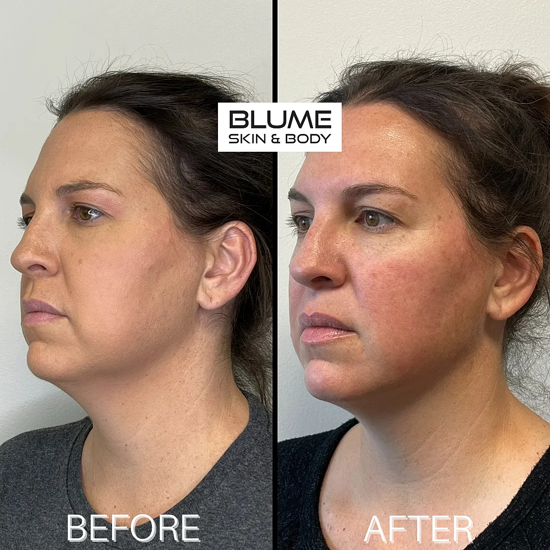 Before and after skin treatment comparison.