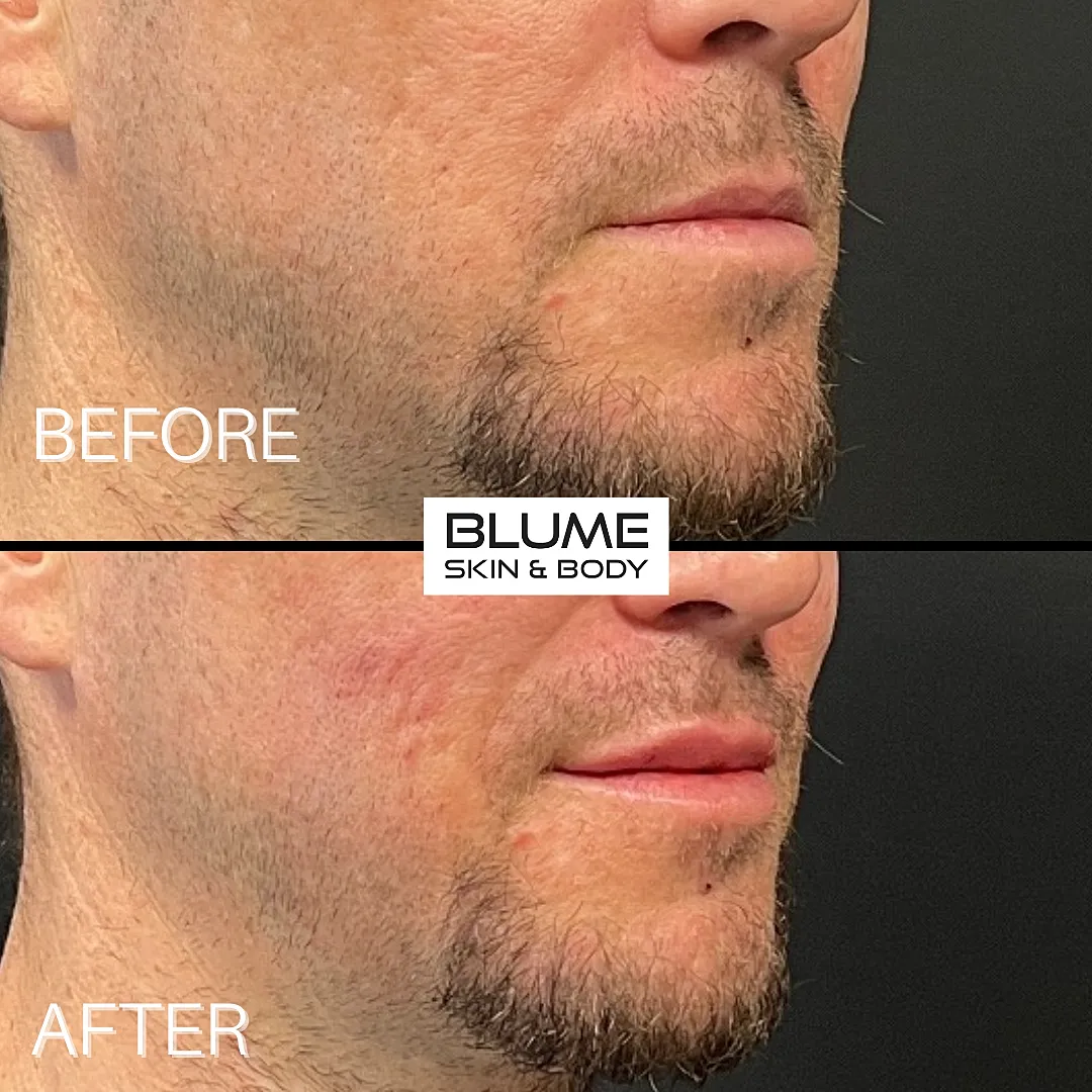 Skin treatment before and after comparison.