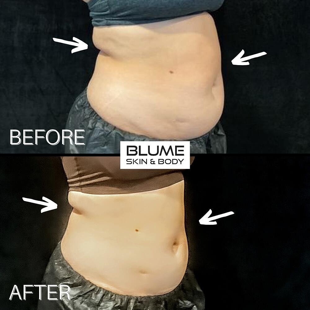 Body Sculpting Before & After
