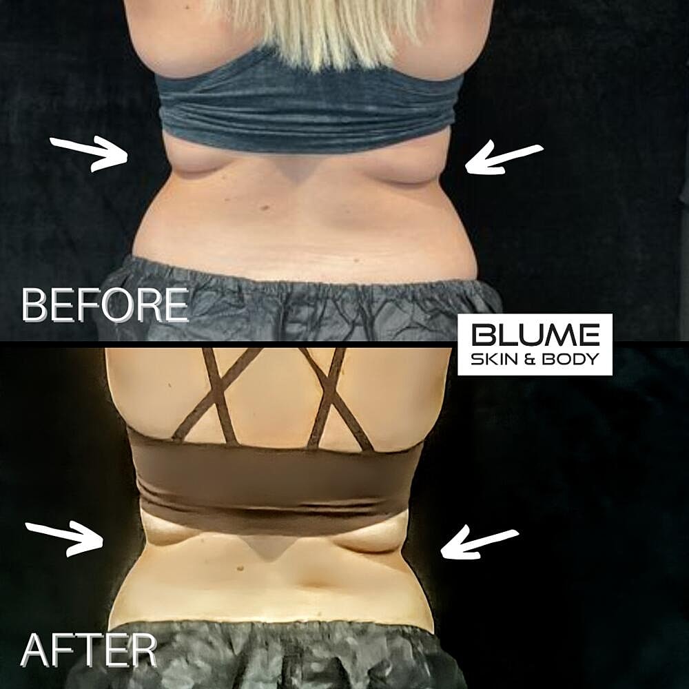 Body Sculpting Before & After