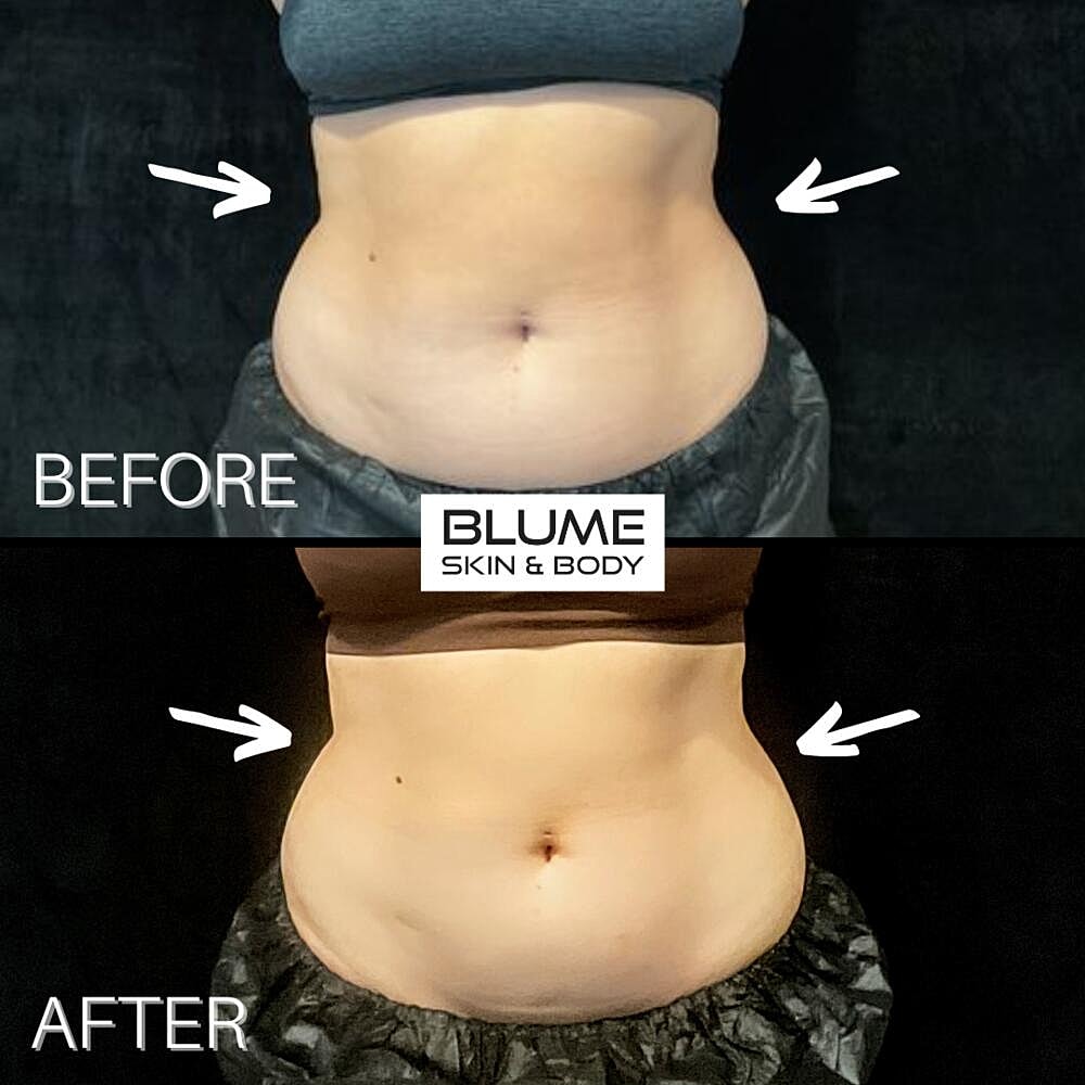 Body Sculpting Before & After