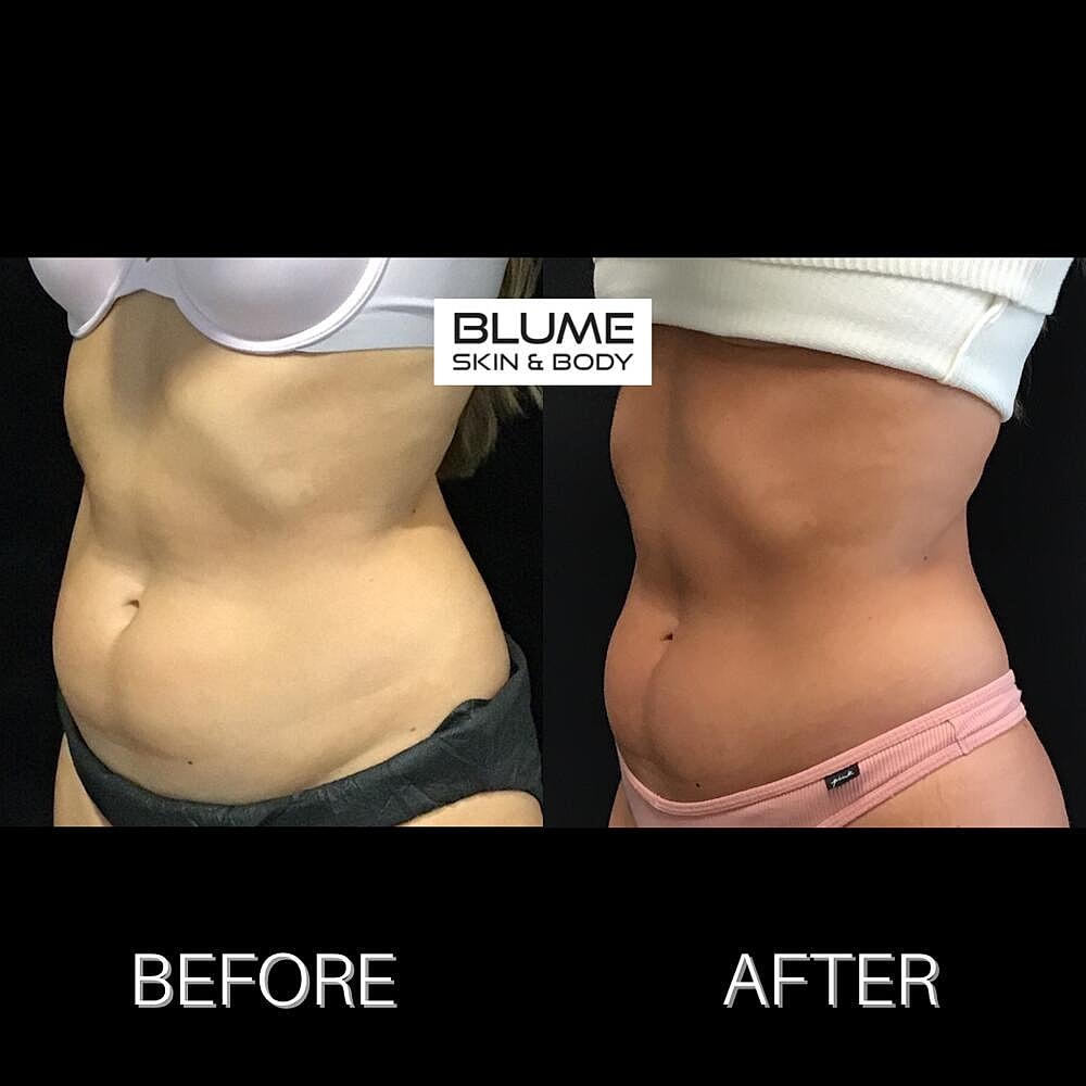 Body Sculpting Before & After