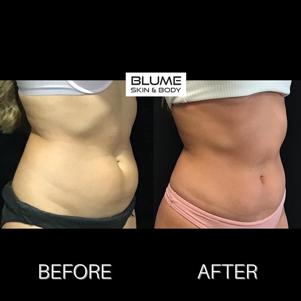 Body Sculpting Before & After