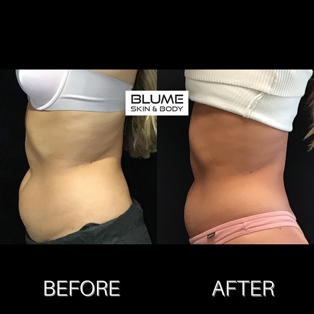 Body Sculpting Before & After
