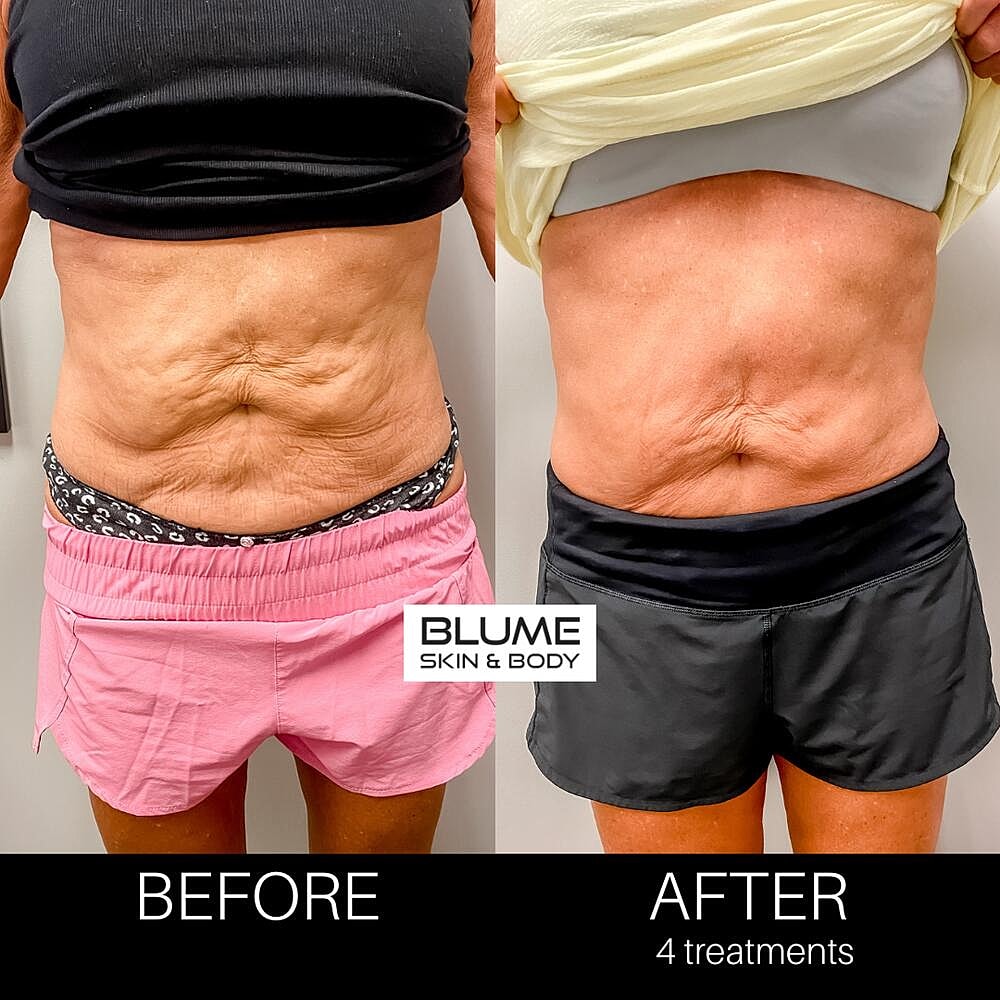 Body Sculpting Before & After