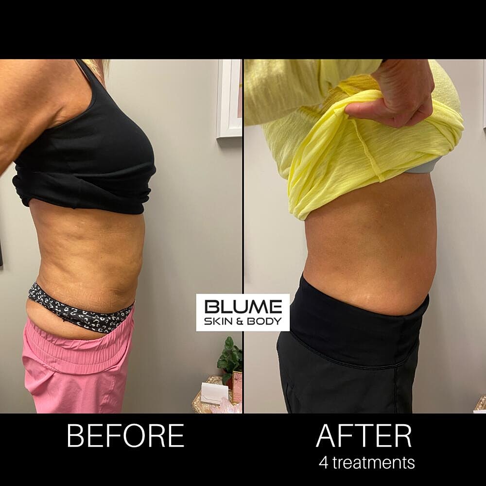 Body Sculpting Before & After