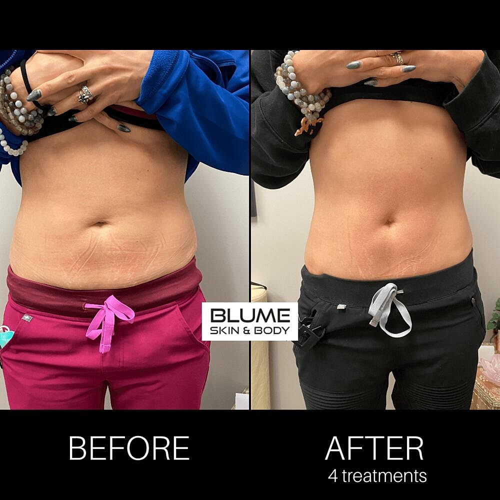 Body Sculpting Before & After
