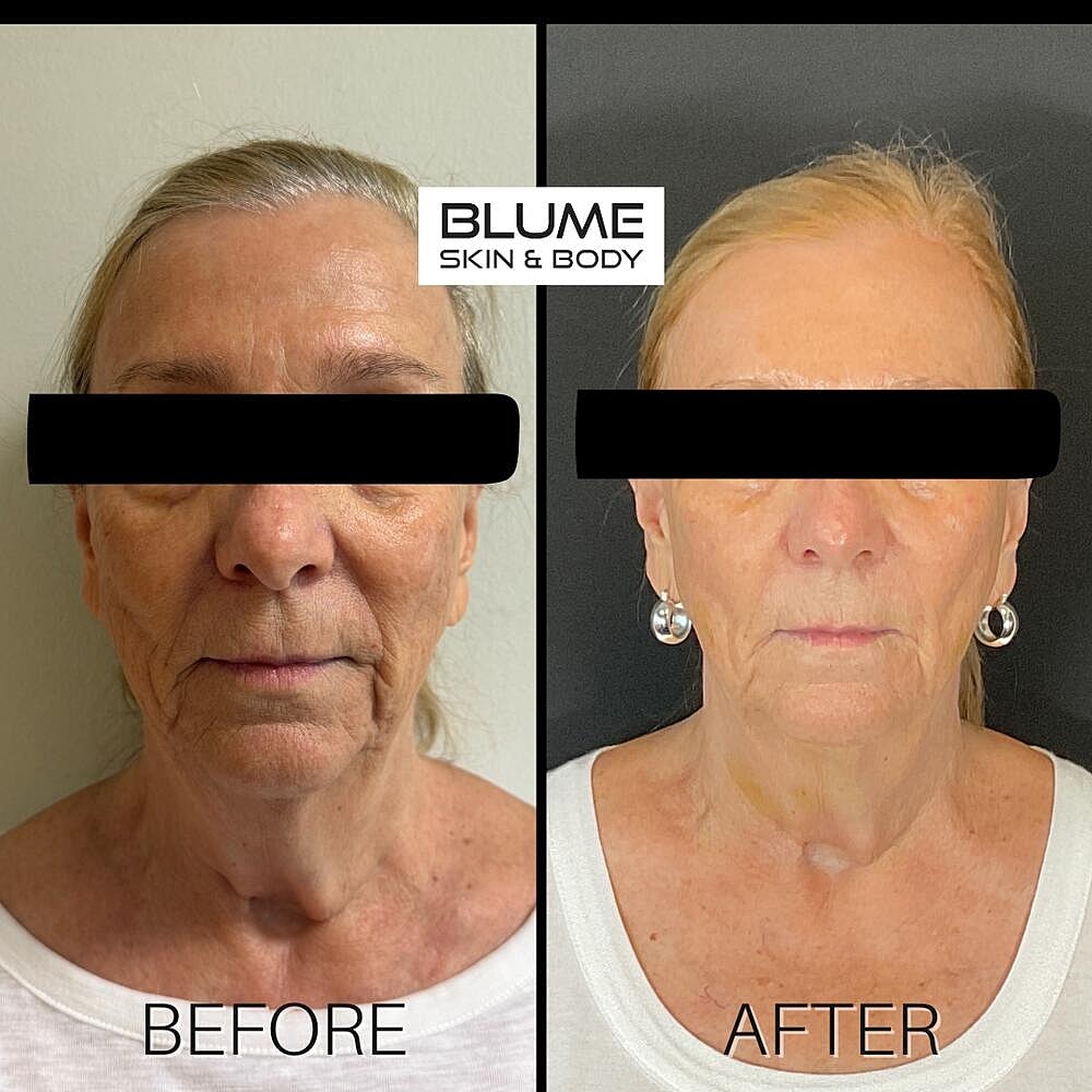 Laser Skin Treatments Before & After