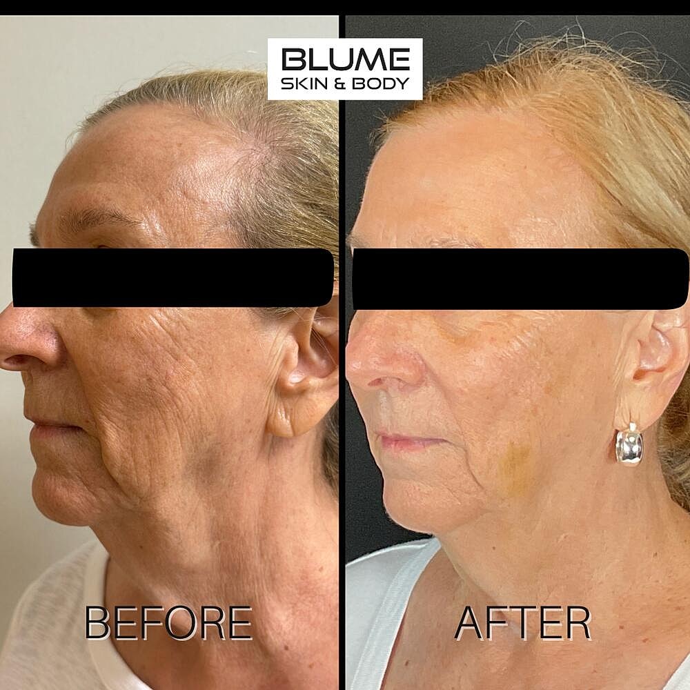 Laser Skin Treatments Before & After