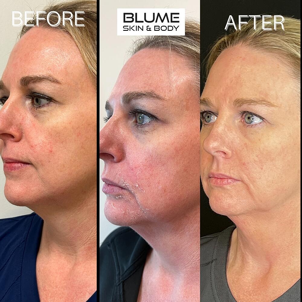 Laser Skin Treatments Before & After