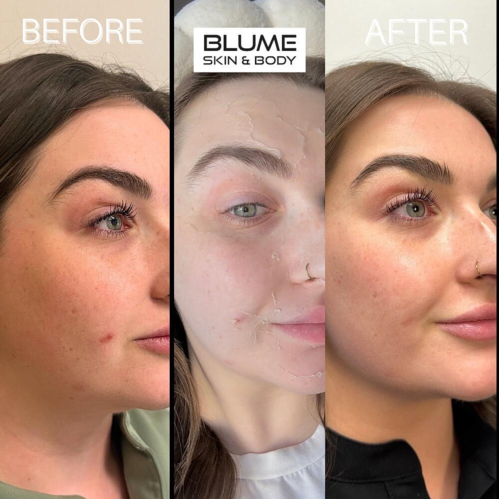 Laser Skin Treatments Before & After