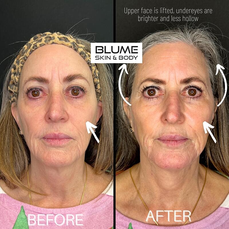Laser Skin Treatments Before & After
