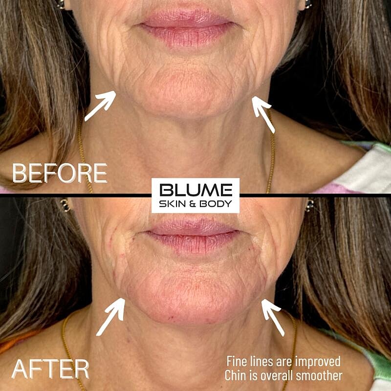 Laser Skin Treatments Before & After