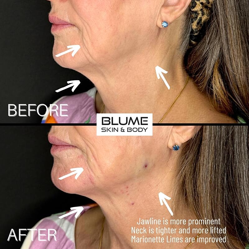 Laser Skin Treatments Before & After
