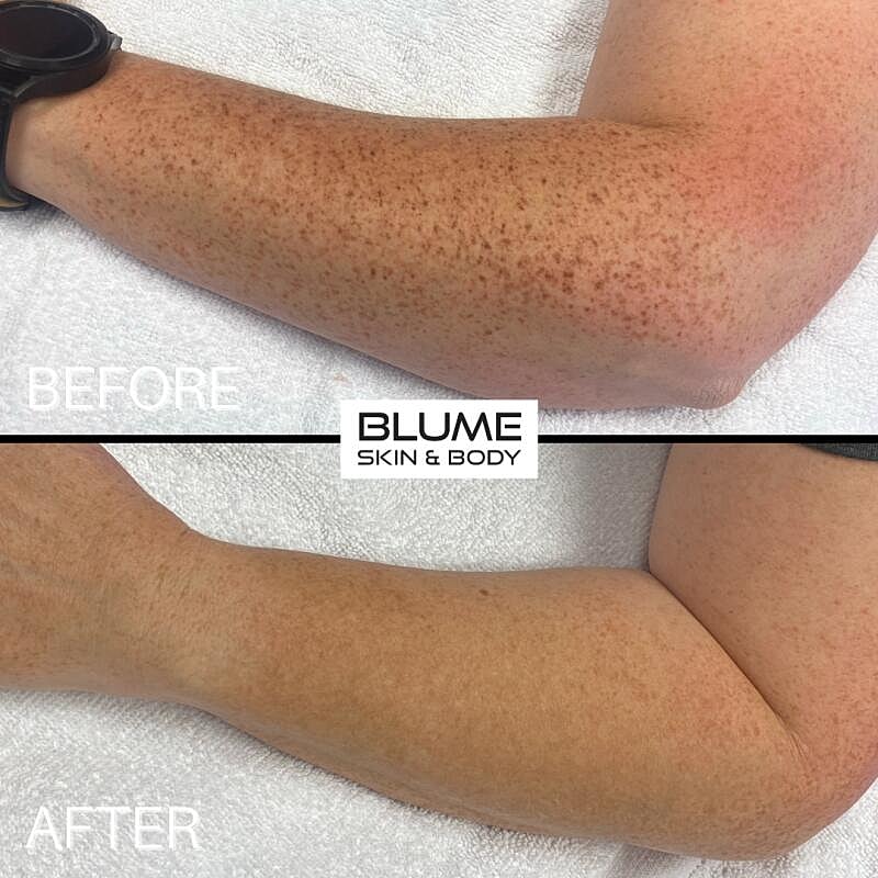 Laser Skin Treatments Before & After