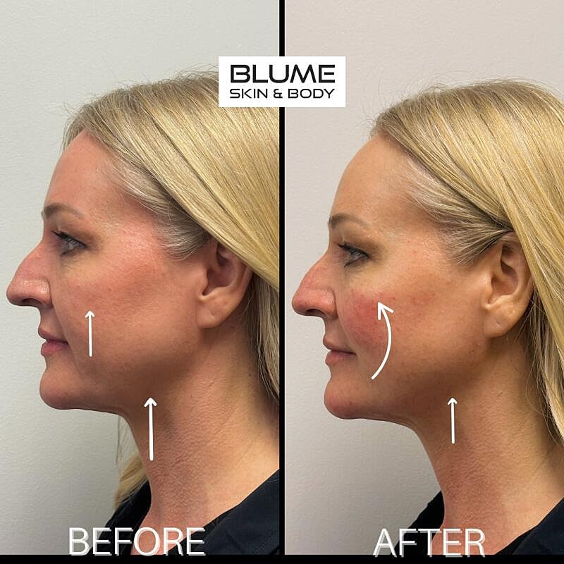 Laser Skin Treatments Before & After