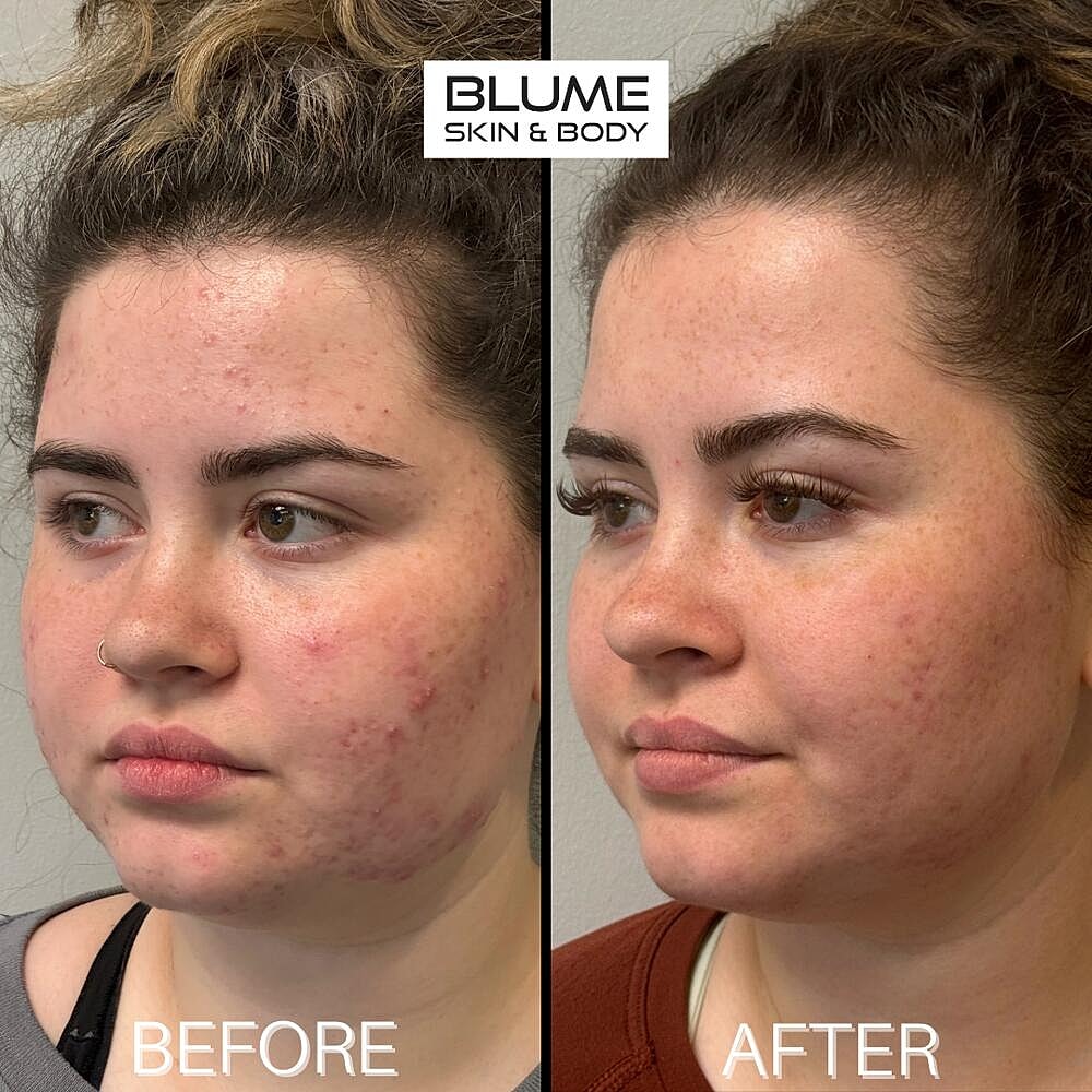 Laser Skin Treatments Before & After