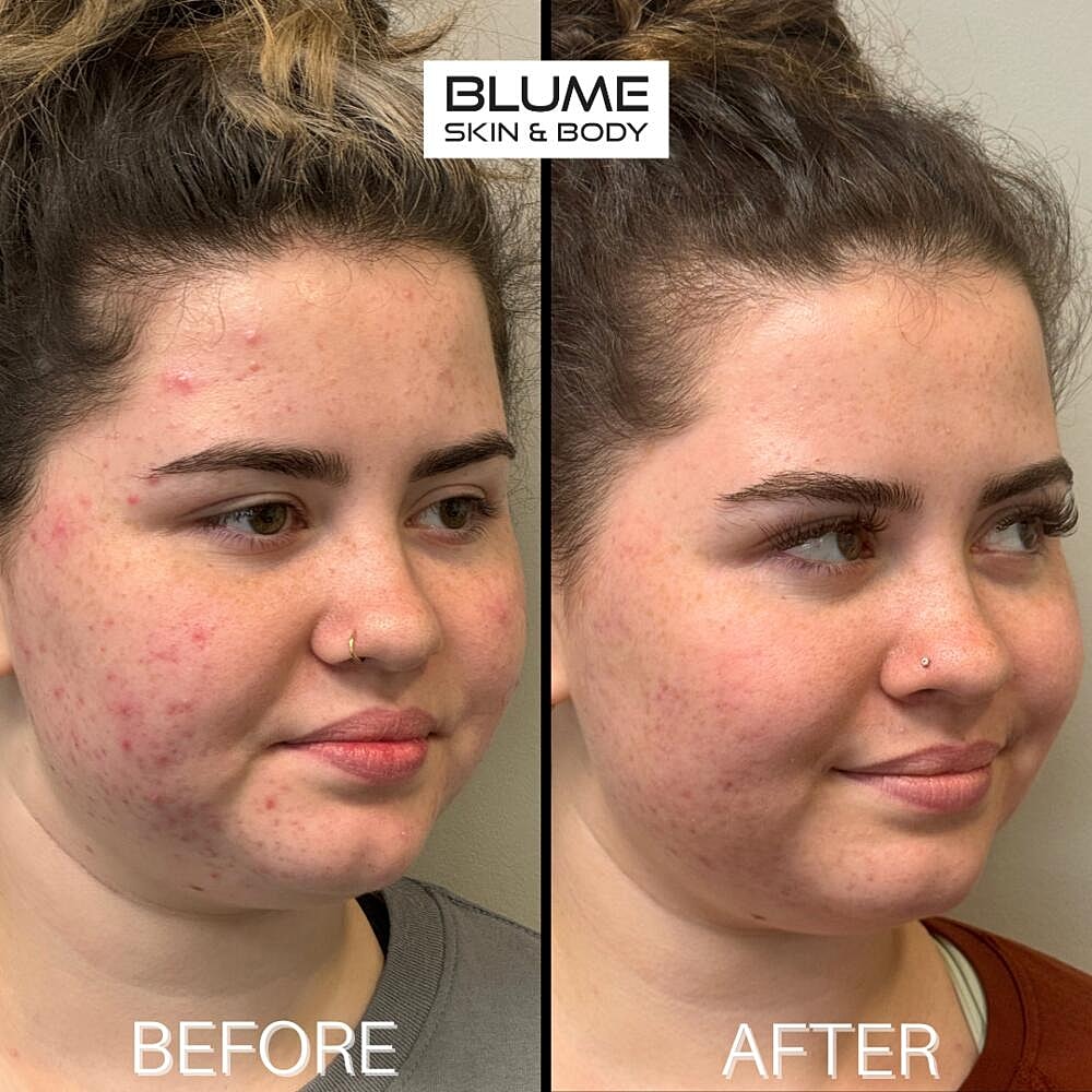 Laser Skin Treatments Before & After