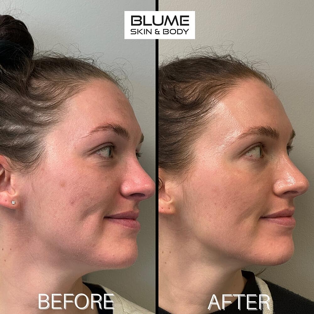 Laser Skin Treatments Before & After
