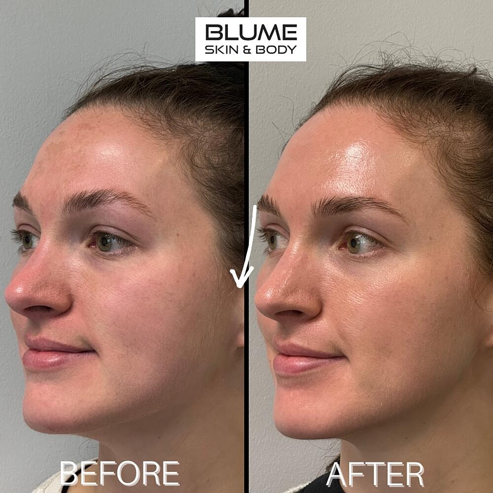 Laser Skin Treatments Before & After