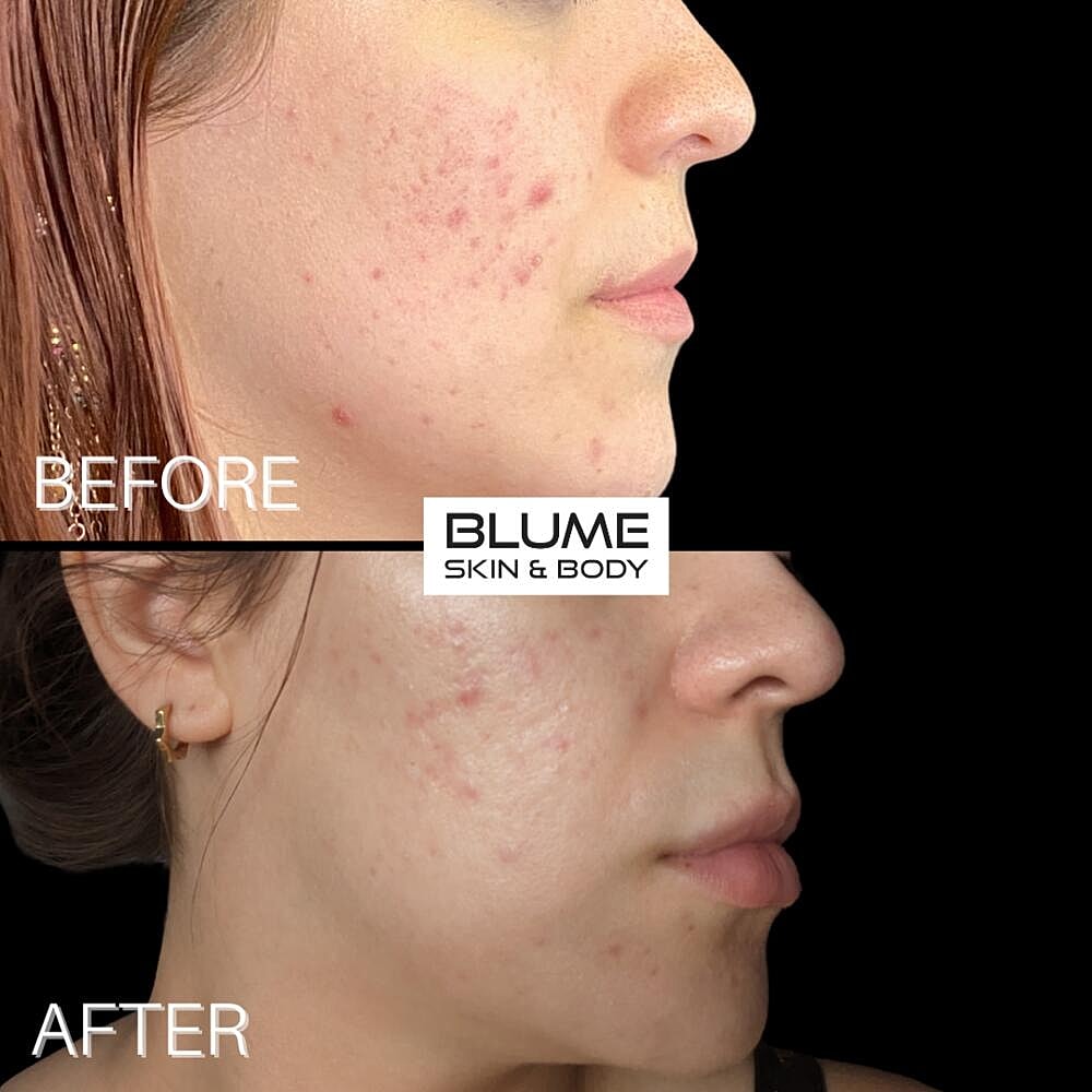 Laser Skin Treatments Before & After