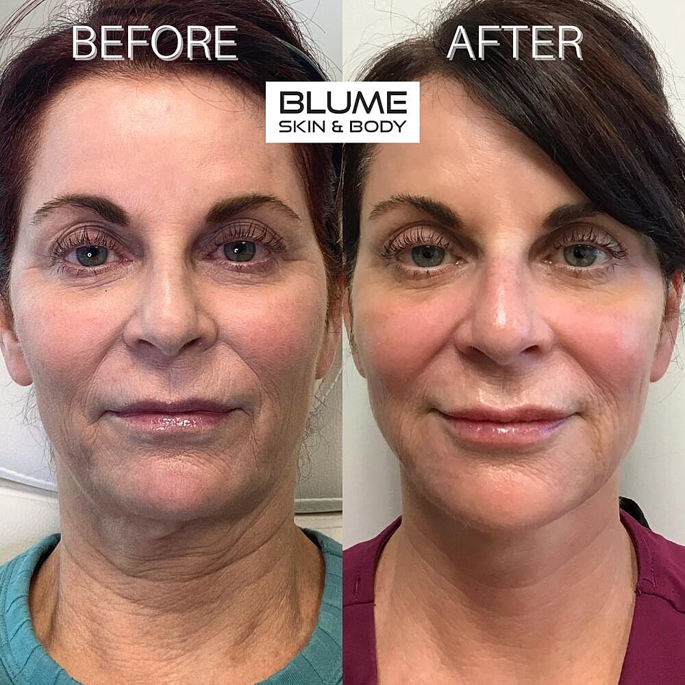 Laser Skin Treatments Before & After