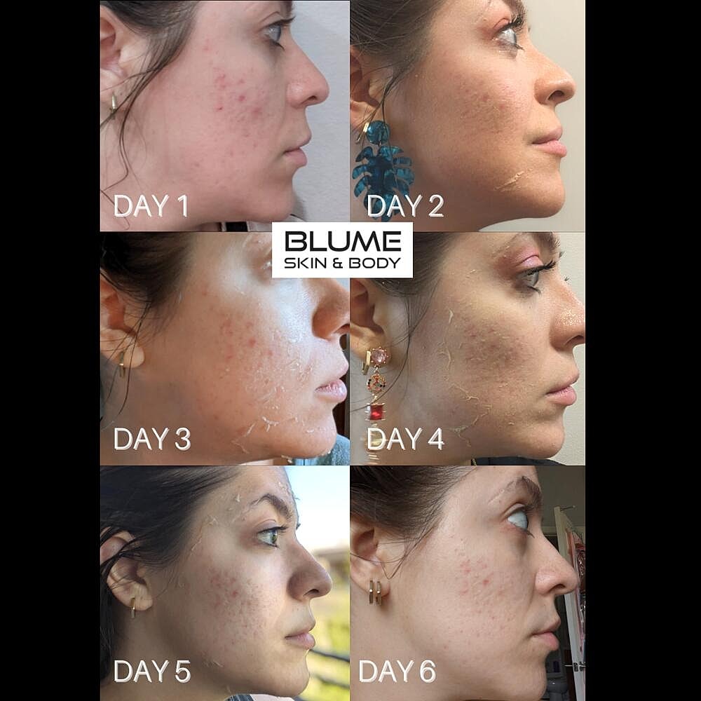 Laser Skin Treatments Before & After