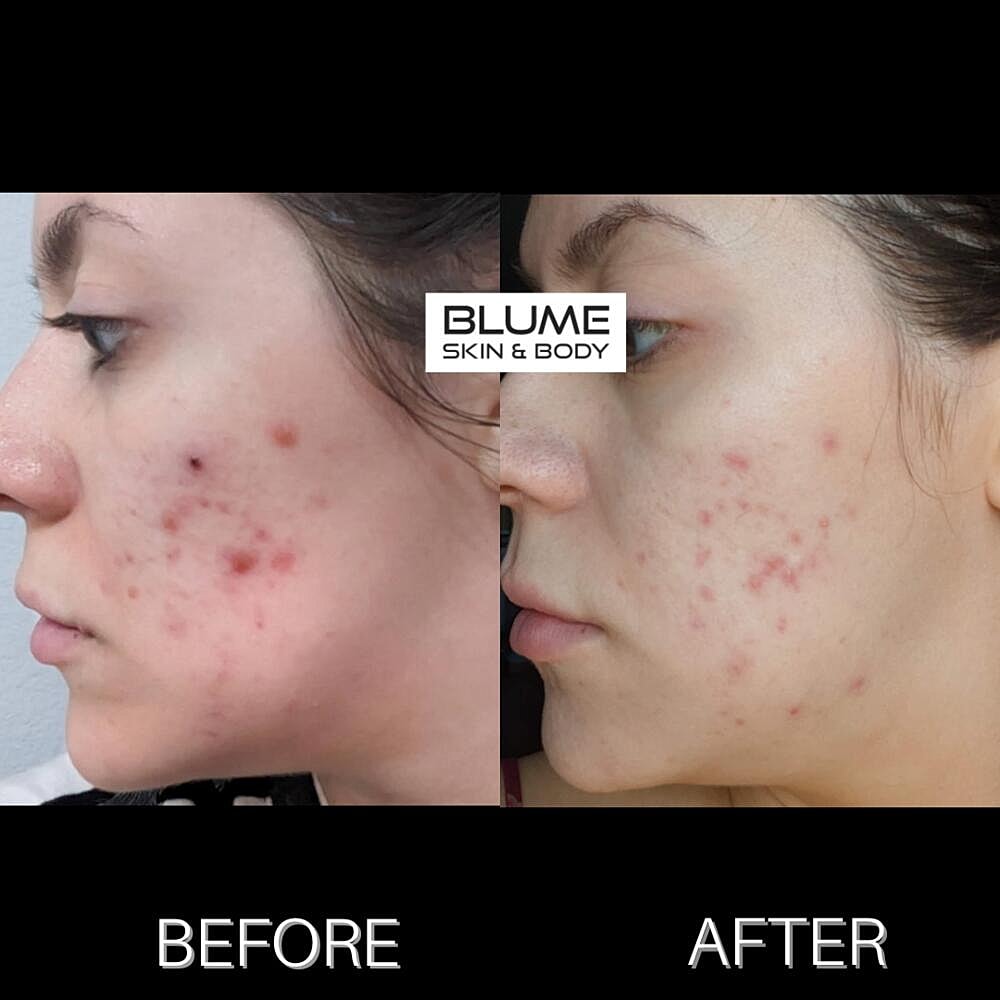 Laser Skin Treatments Before & After