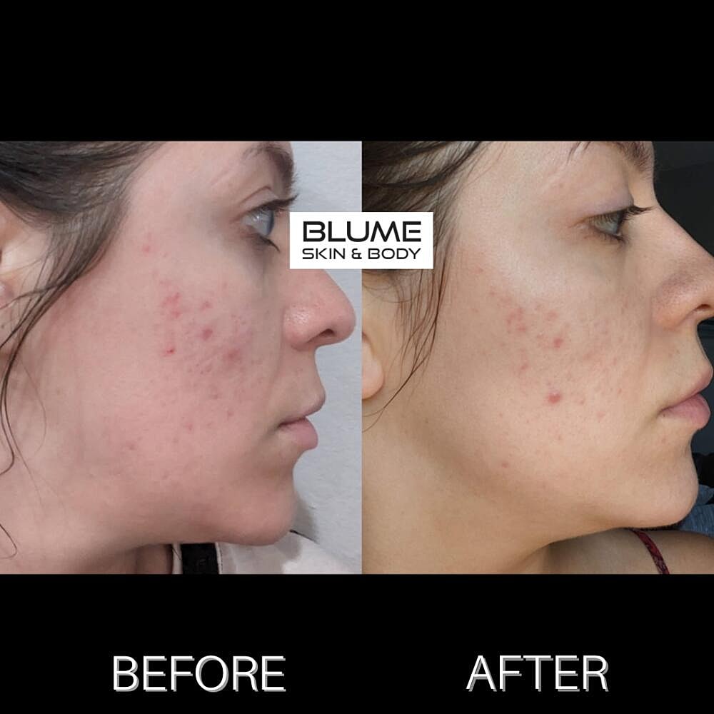 Laser Skin Treatments Before & After