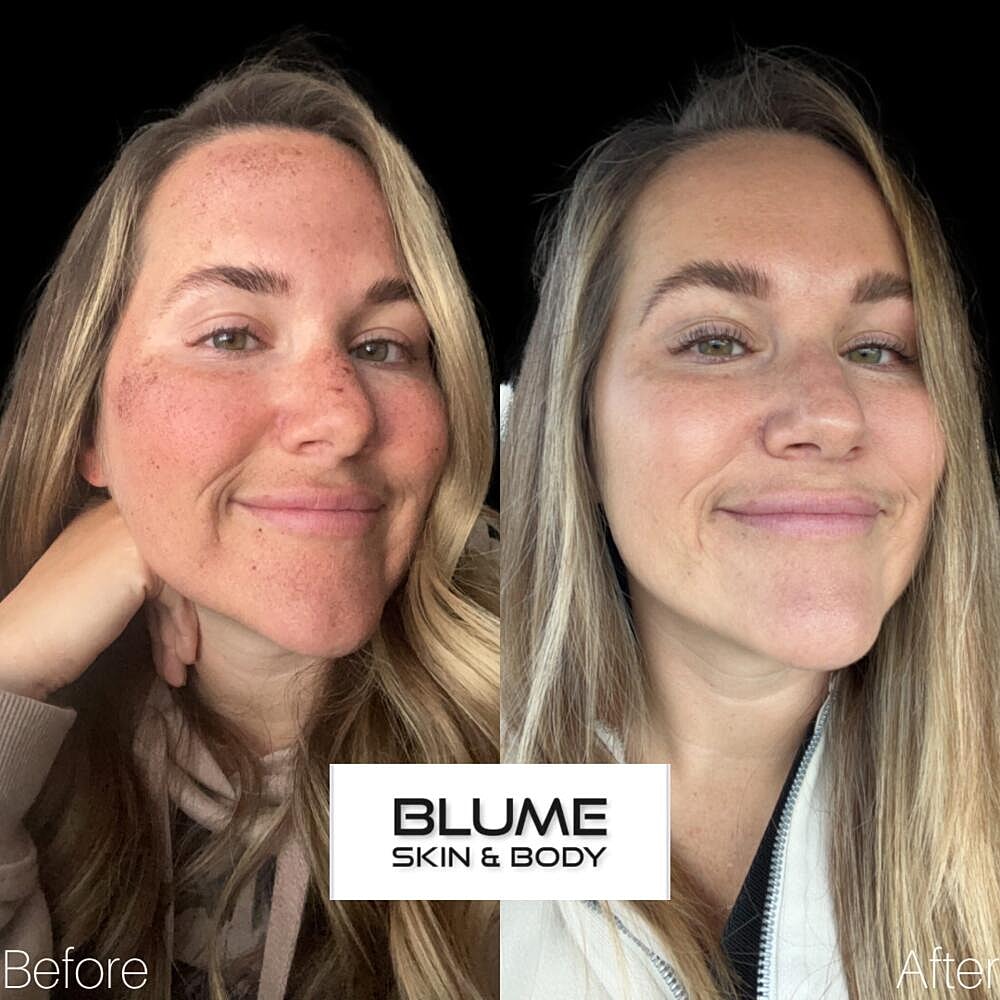 Laser Skin Treatments Before & After