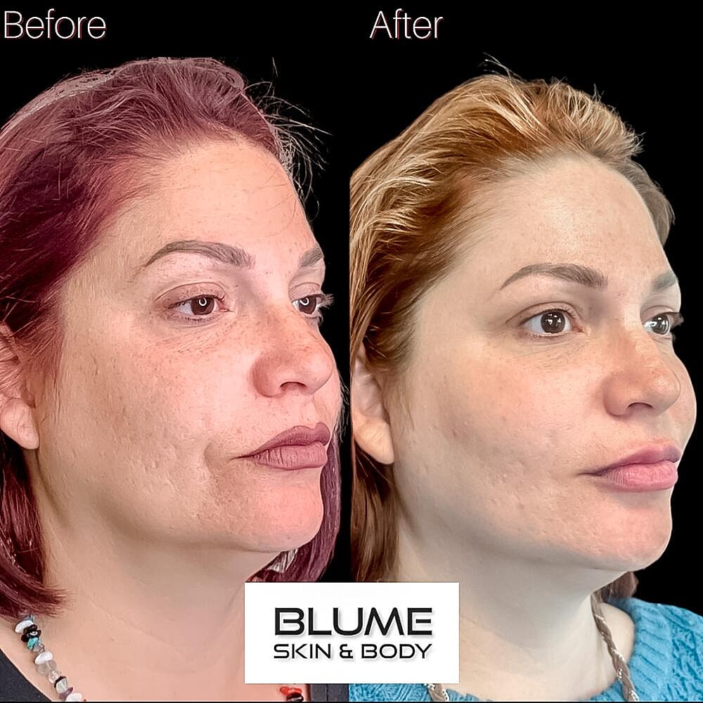 Laser Skin Treatments Before & After