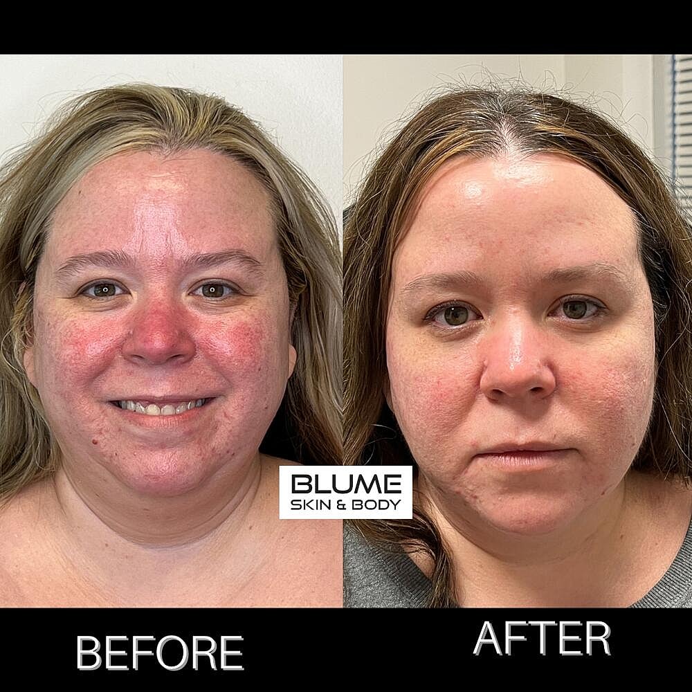 Laser Skin Treatments Before & After