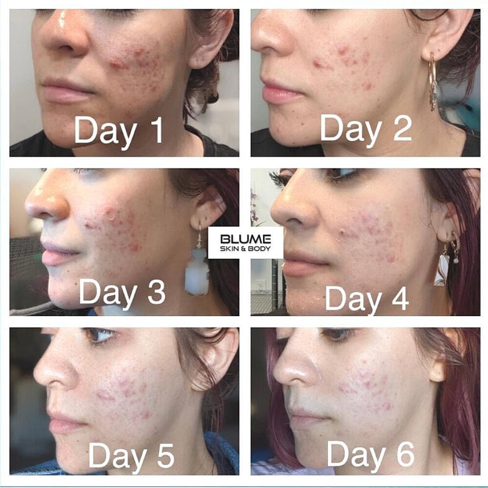 Laser Skin Treatments Before & After